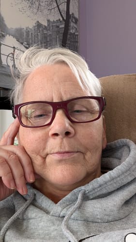 Reviewer's face after using the Seranova Micro Infusion System, noting visible improvement around mouth and jowls.