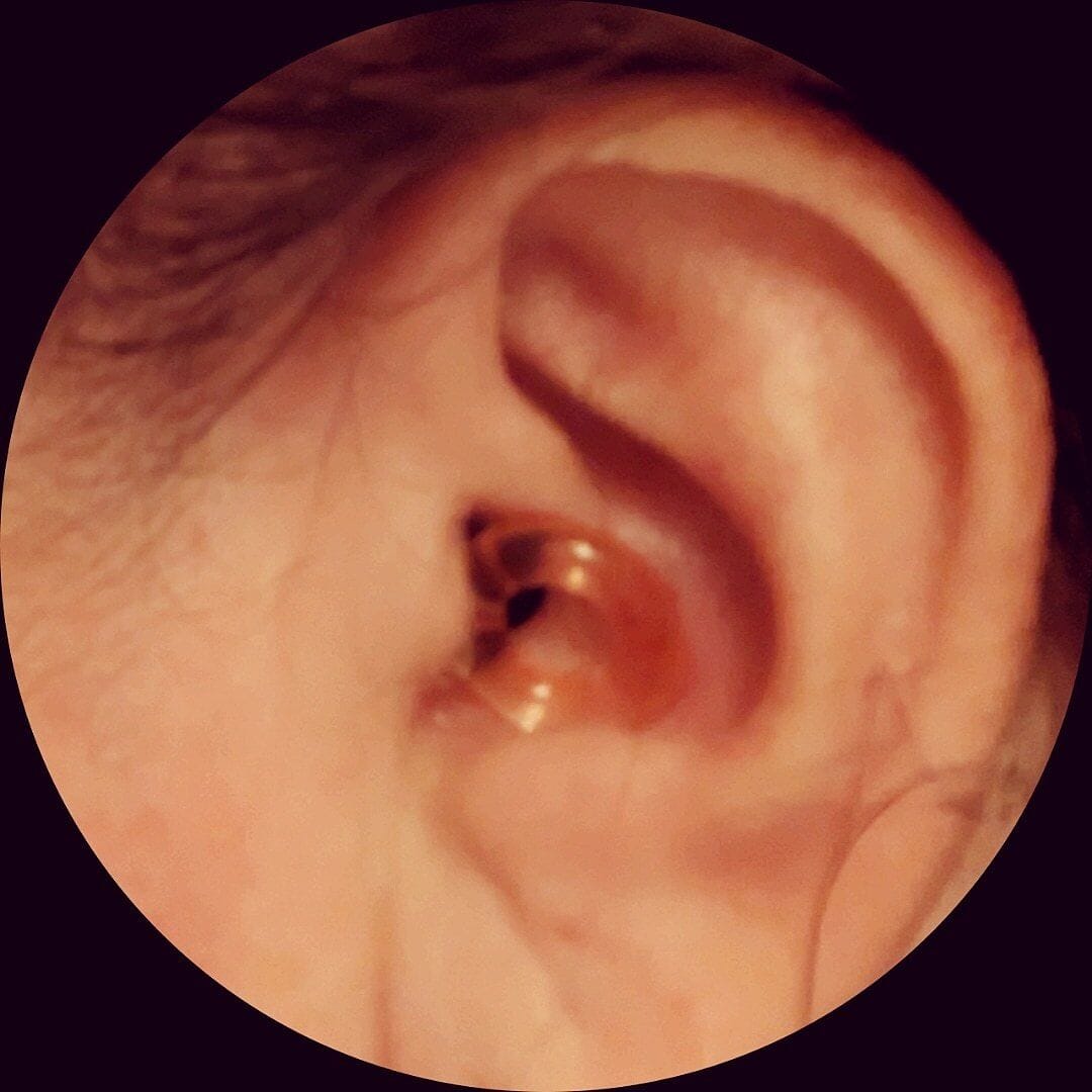 Customer photo review of Foam Ear tips + Loop Mute