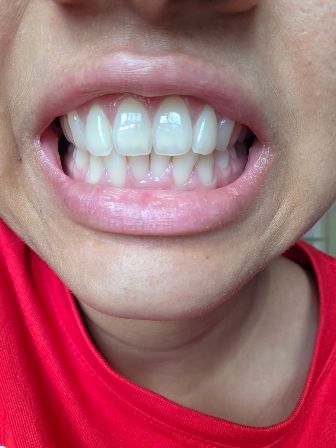 Customer photo review of Restore+ n-HA Prebiotics Whitening Toothpaste