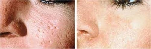 Customer photo review of Derma Stamp Micro Needling Skin Tool