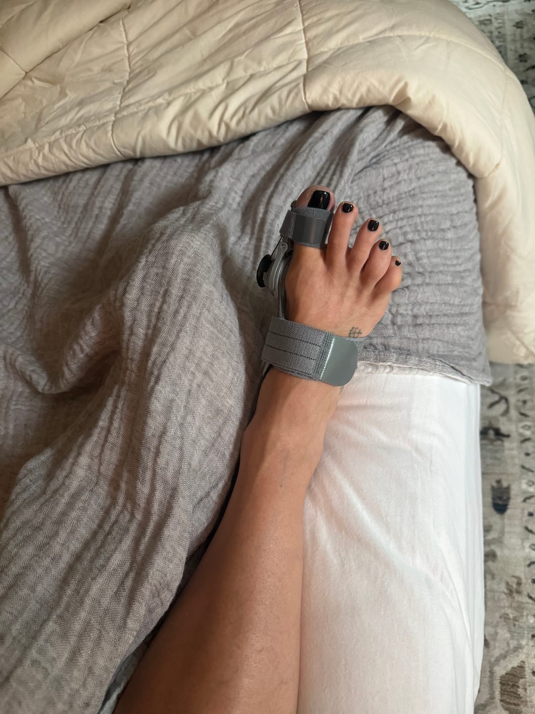 Customer photo review of Treatmedy™ Bunion Fix