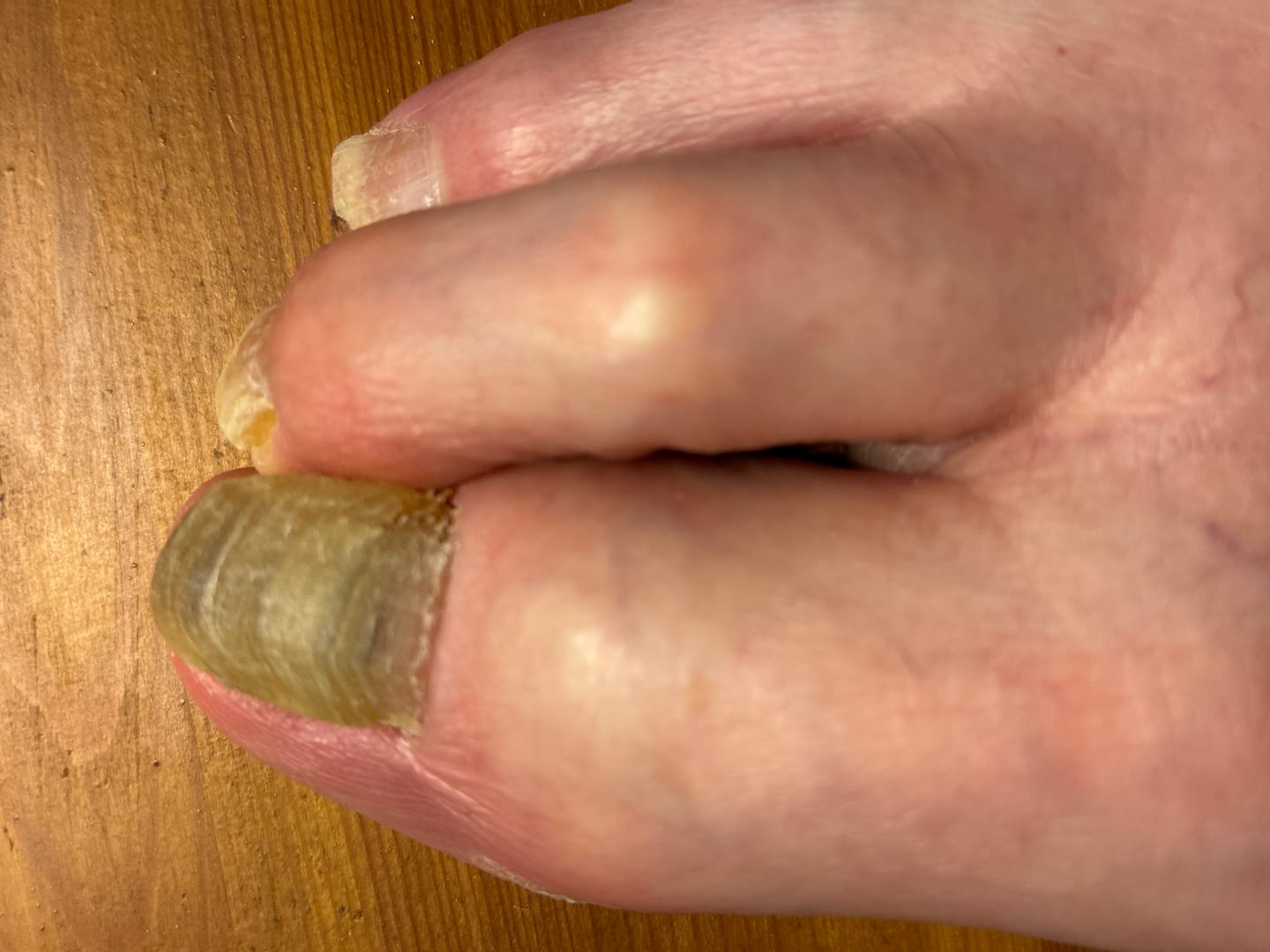 Customer photo review of VELCURA™ Fungal Nail Patches