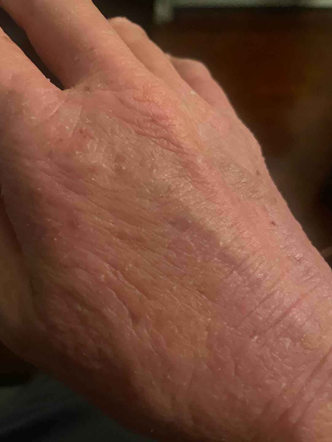 Customer photo review of EczPro - Probiotics for Eczema, Natural Remedy, 13 Histamine-Safe Strains, Allergen-Free Formula