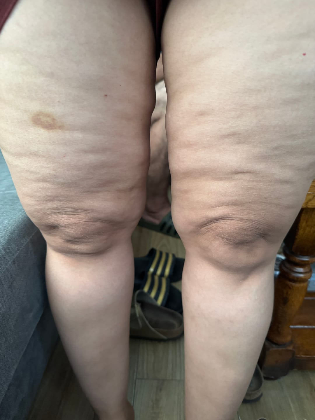 Customer photo review of Body For Us Anti-Cellulite Massage Oil