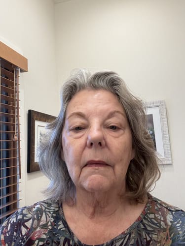 Reviewer showing face before using the Micro Infusion System, highlighting skin texture and facial features.