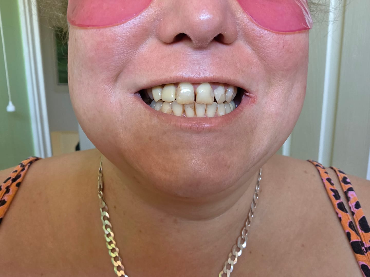 Customer photo review of Composite Care Bundle