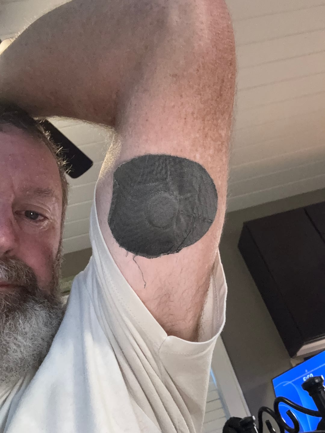 Customer photo review of Skin Grip Original - Medtronic Guardian/Enlite Adhesive Patches
