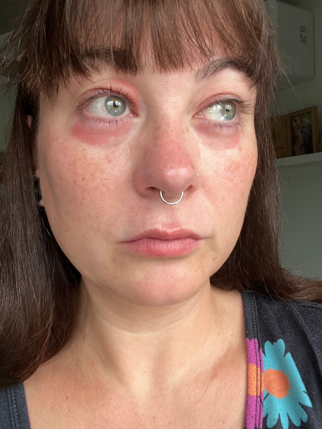 Customer photo review of Calm Skin-Relief Kit