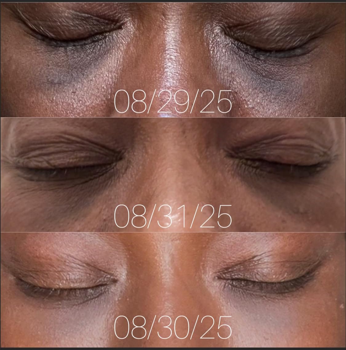 Customer photo review of Tosowoong Arbutin Brightening Cream