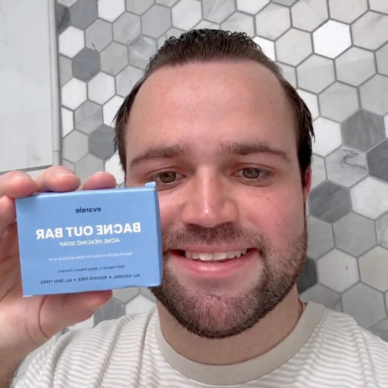 Customer photo review of Barra Anti Acne™