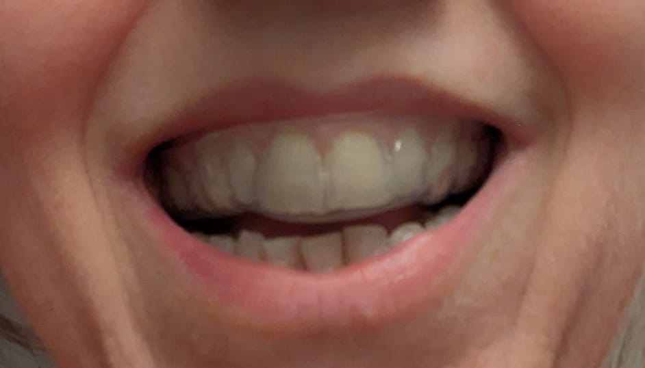 Customer photo review of 3.0mm Soft Night Guards