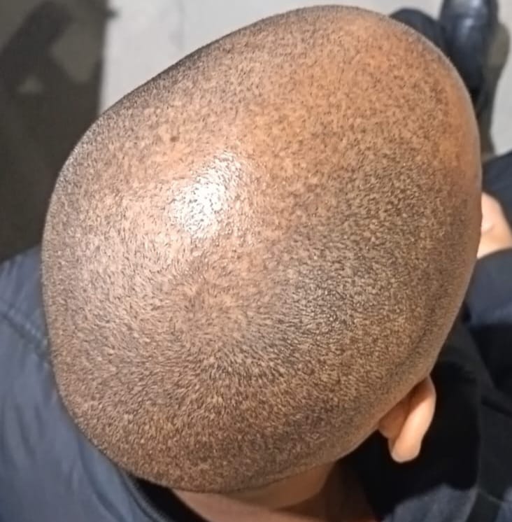 Customer photo review of Minoxidil 5% +DHT Blocker FOAM, MEN ONLY,  3 Month supply