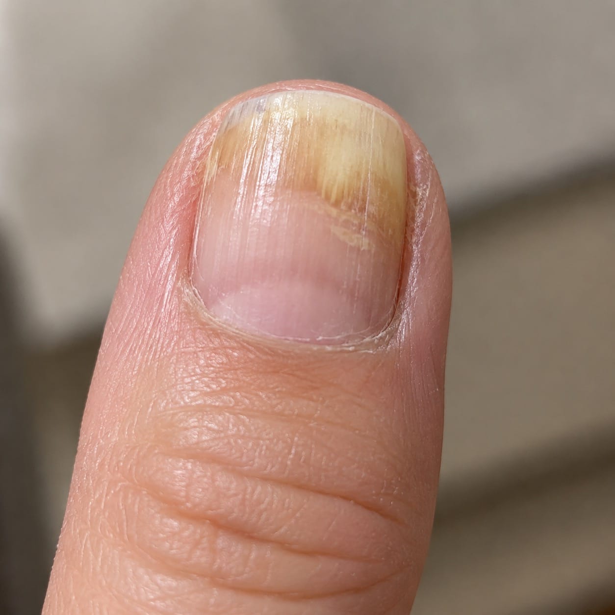 Customer photo review of Aurely-Care™ UV-Nageltherapiegerät