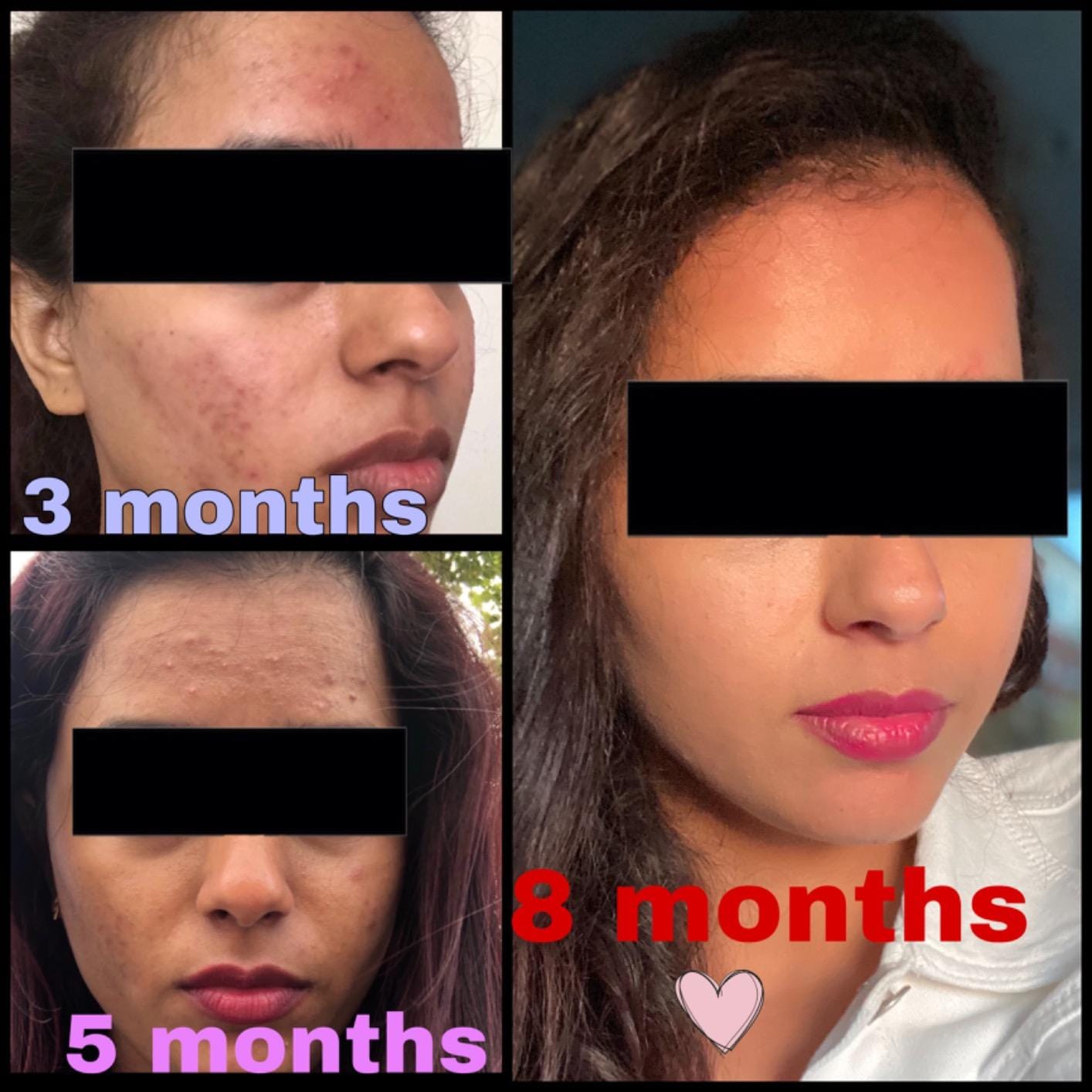 Customer photo review of Silicone Led Light Therapy Mask