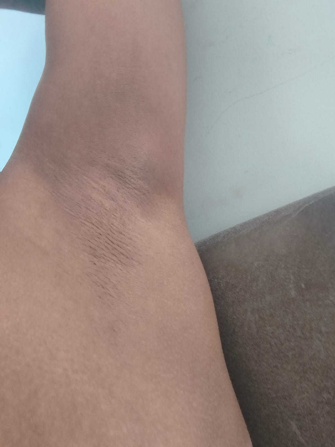 Customer photo review of Creme Clareador de Manchas – Melasma, Axilas, Virilha, Áreas Íntimas, Rosto e Corpo