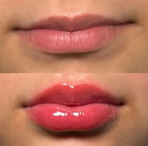 Customer photo review of Voluminizador de Labios – Efecto Inmediato