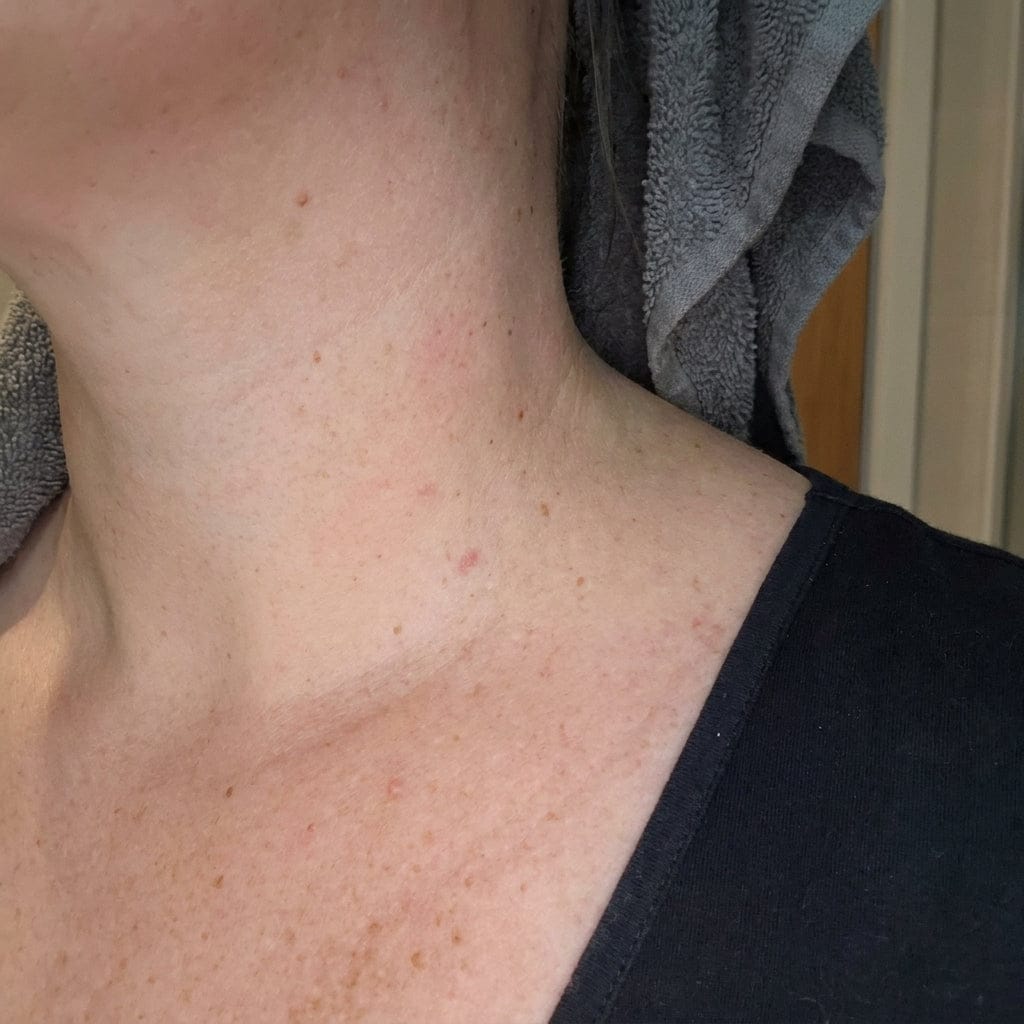 Customer photo review of SUVORA™-Kit Indoloro para Verrugas Colgantes