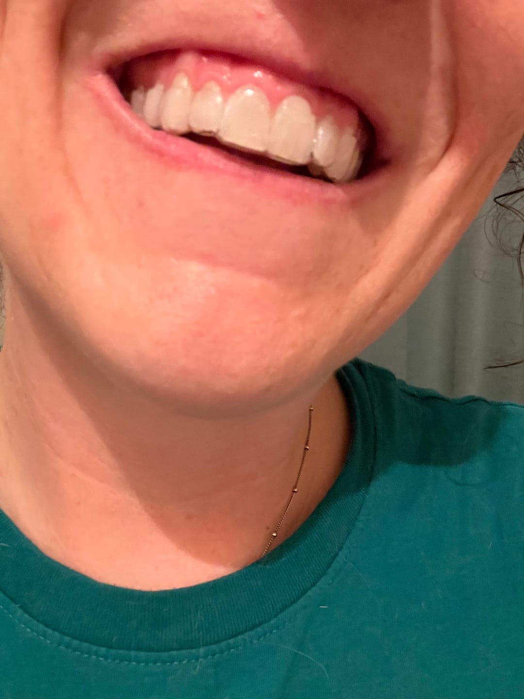 Customer photo review of Custom Night Guards