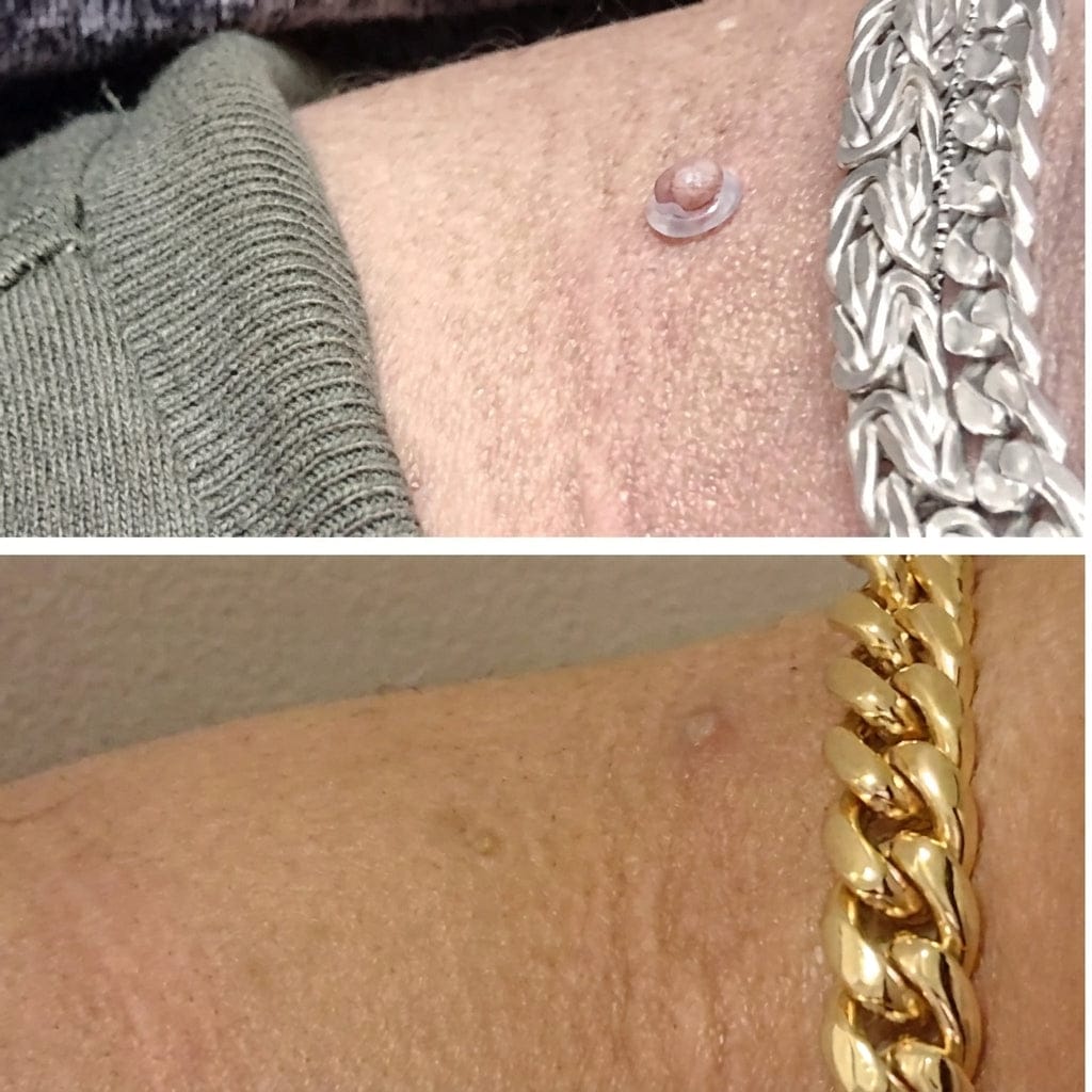 Customer photo review of SUVORA™-Kit Indoloro para Verrugas Colgantes