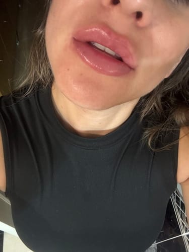Customer photo review of Voluminizador de Labios – Efecto Inmediato