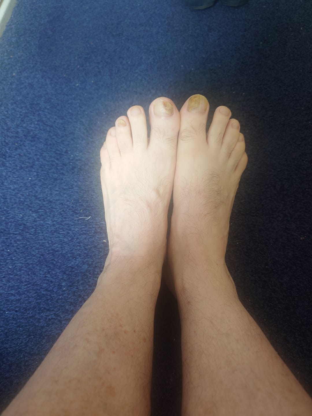 Customer photo review of VELCURA™ Fungal Nail Patches