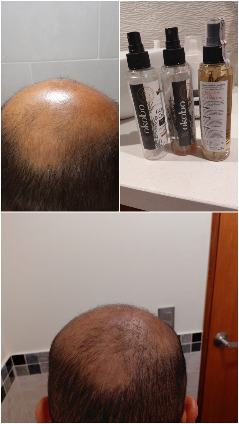 Customer photo review of 3 Tónicos Capilares de Romero · Crecimiento y Anticaída + Dermaroller de regalo