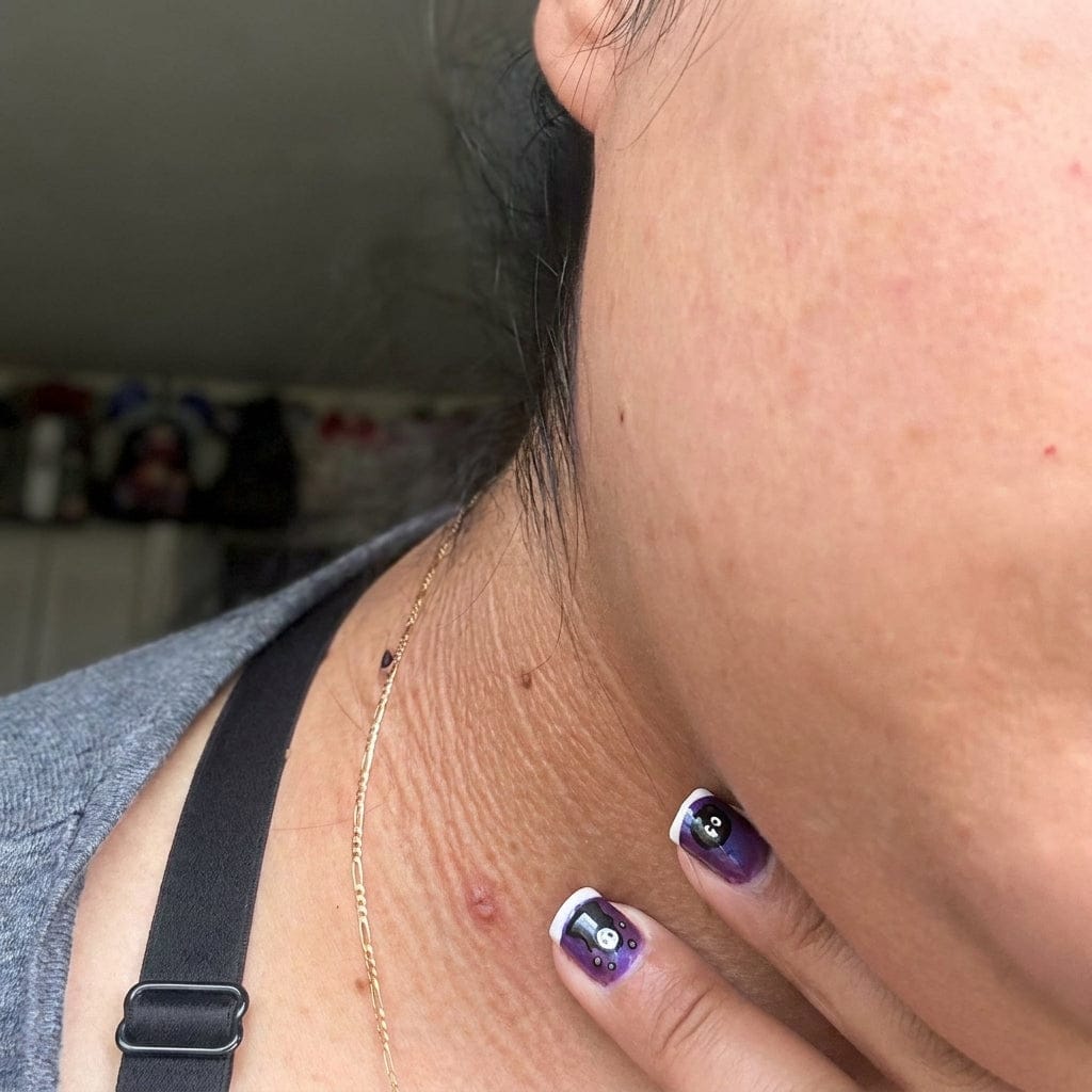 Customer photo review of SUVORA™-Kit Indoloro para Verrugas Colgantes