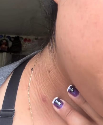 Customer photo review of Kit Elimina Verrugas