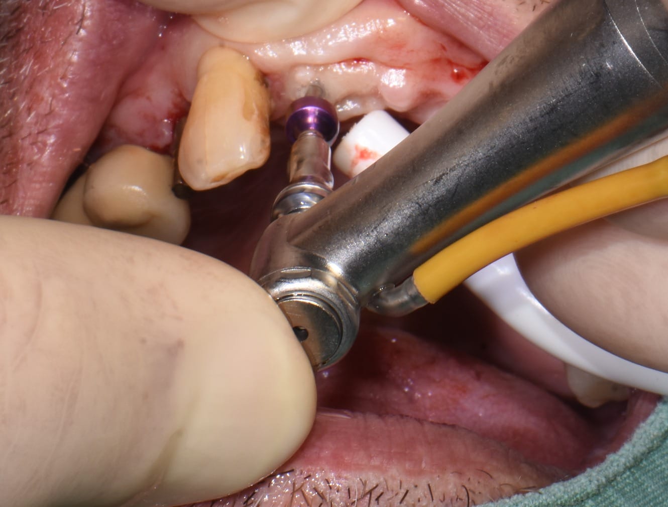 Customer photo review of ALTO® One-Piece Dental Implant Ø3.5 immediate load - Monoblock System