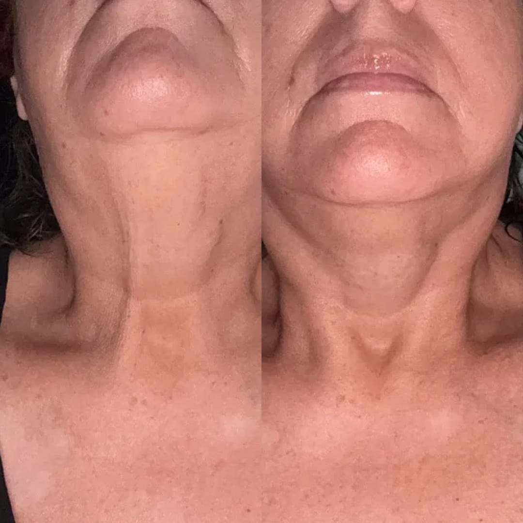 Customer photo review of קרם לצוואר רפוי וקמטוטים - למראה מתוח, מוצק וצעיר יותר