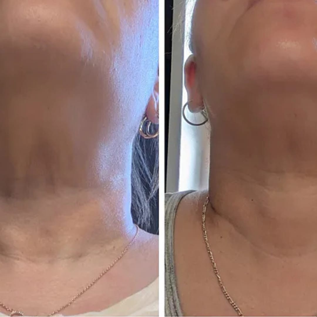 Customer photo review of קרם לצוואר רפוי וקמטוטים - למראה מתוח, מוצק וצעיר יותר