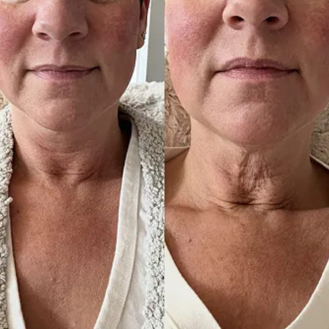 Customer photo review of קרם לצוואר רפוי וקמטוטים - למראה מתוח, מוצק וצעיר יותר