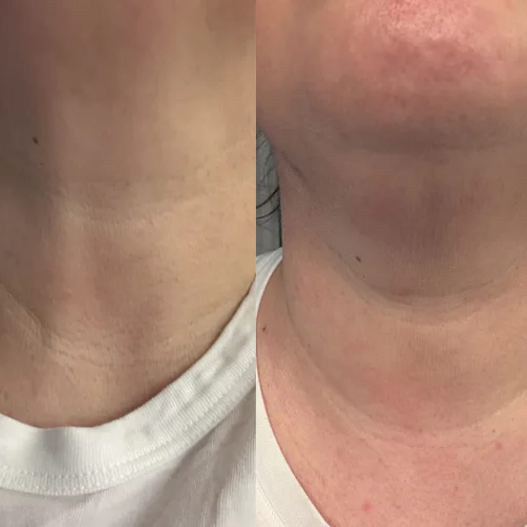 Customer photo review of קרם לצוואר רפוי וקמטוטים - למראה מתוח, מוצק וצעיר יותר