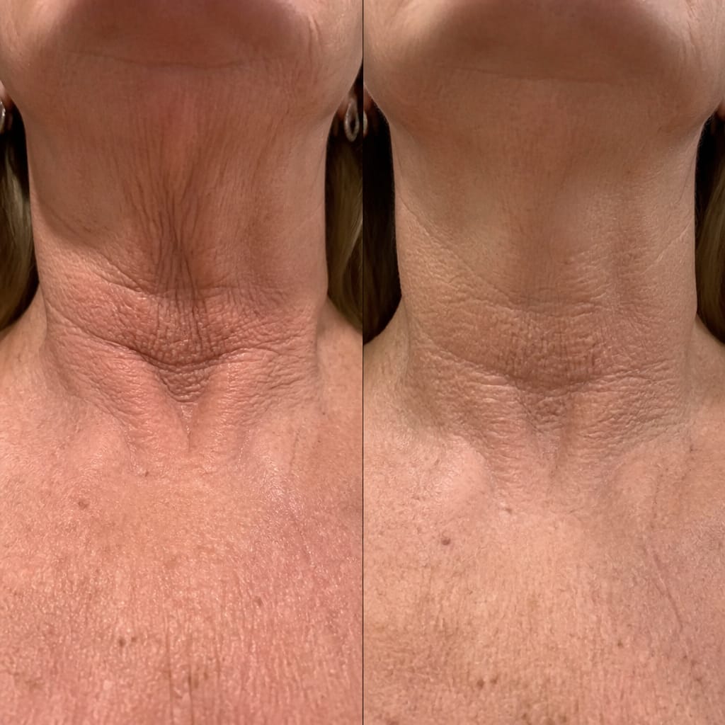 Customer photo review of Miyo - Retinal Shot