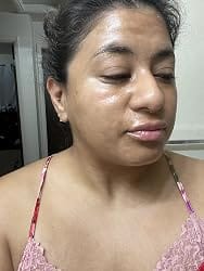 Customer photo review of CollaVeil™ Overnight Mask