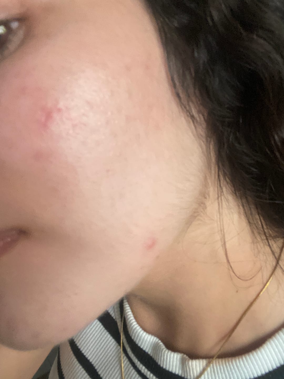 Customer photo review of A CONTROL - ACNÉ HORMONAL & RESISTENCIA A LA INSULINA