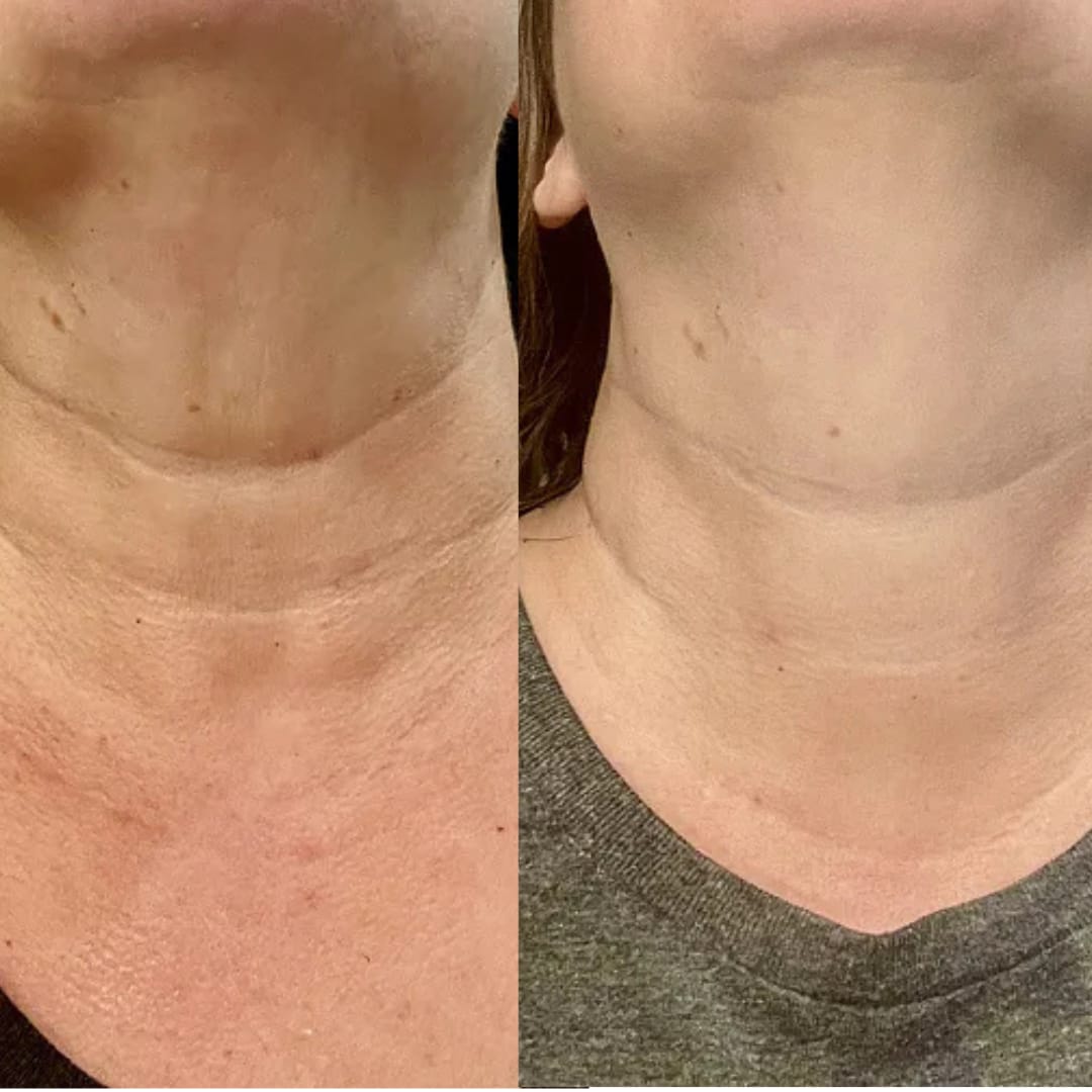 Customer photo review of קרם לצוואר רפוי וקמטוטים - למראה מתוח, מוצק וצעיר יותר