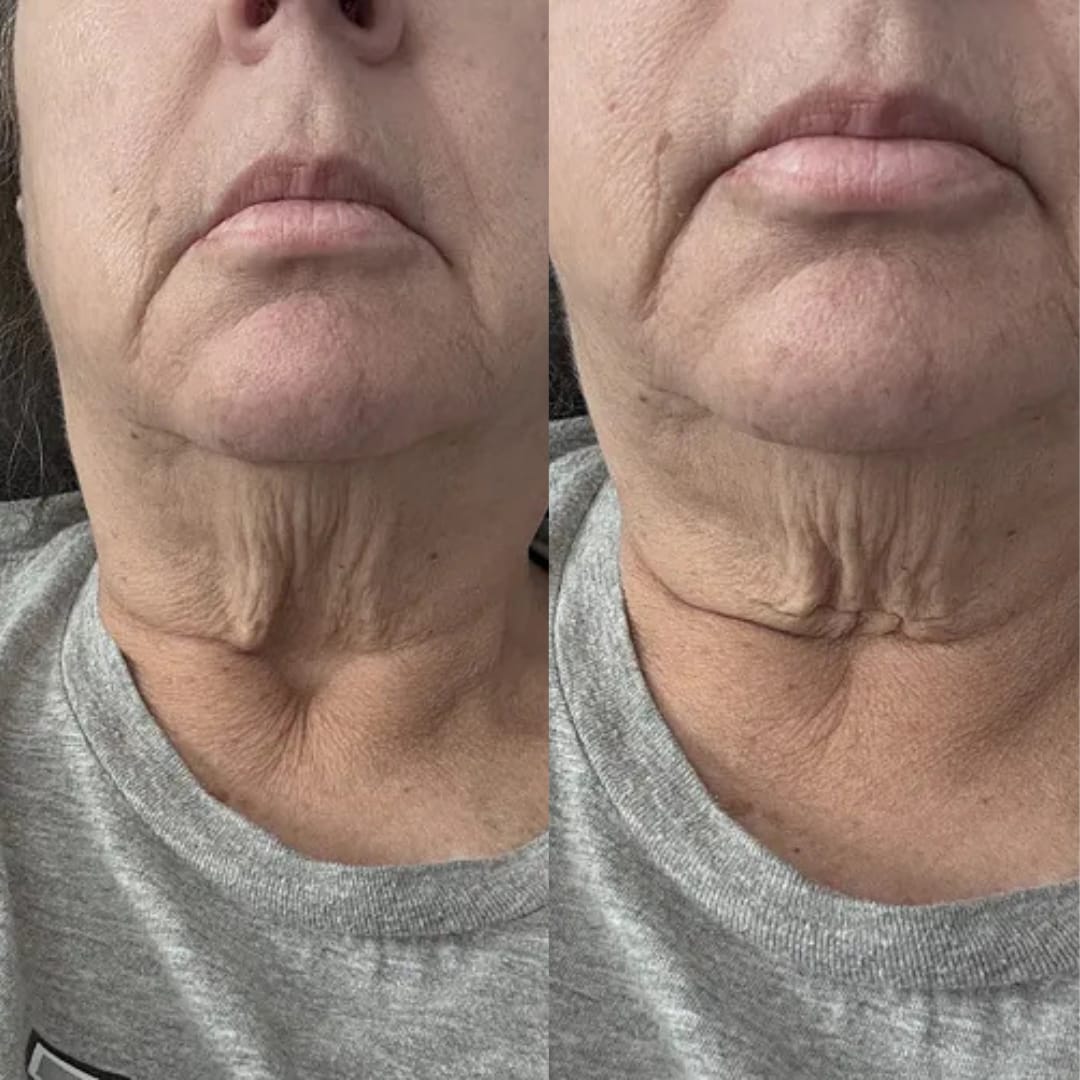 Customer photo review of קרם לצוואר רפוי וקמטוטים - למראה מתוח, מוצק וצעיר יותר