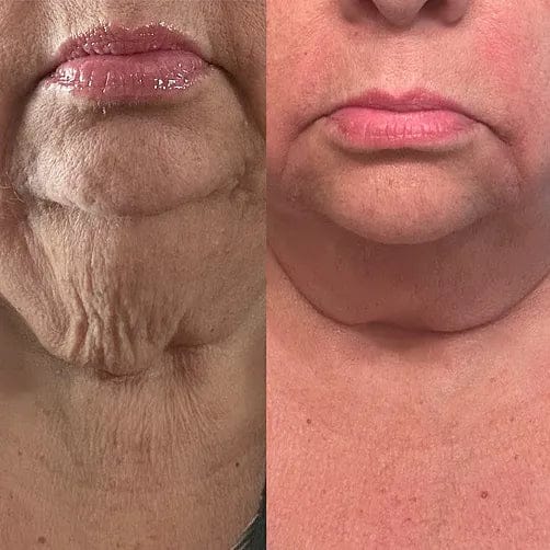 Customer photo review of קרם לצוואר רפוי וקמטוטים - למראה מתוח, מוצק וצעיר יותר