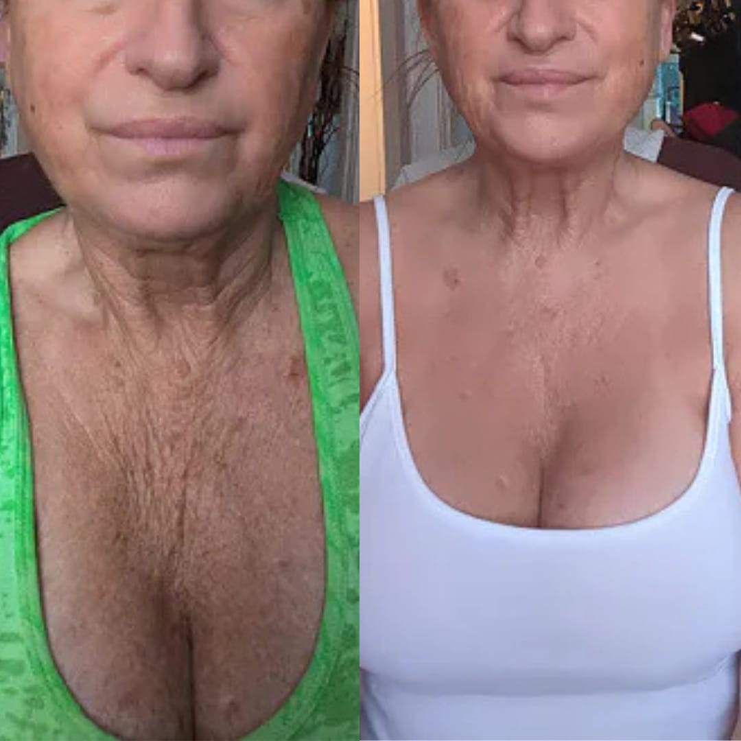 Customer photo review of קרם לצוואר רפוי וקמטוטים - למראה מתוח, מוצק וצעיר יותר