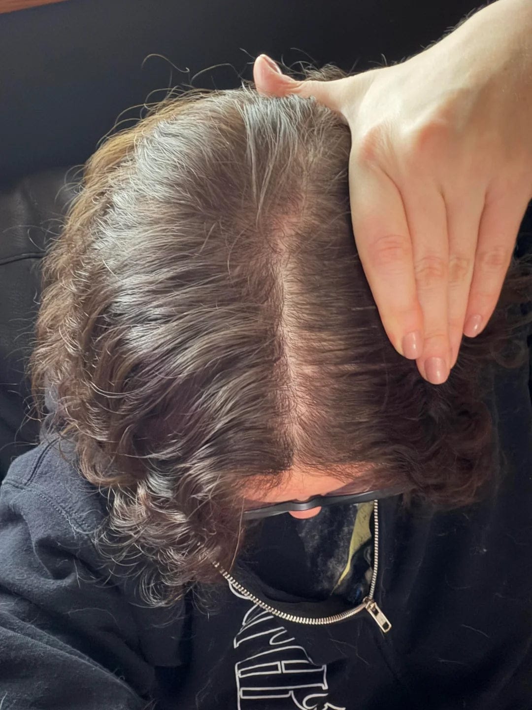 Customer photo review of Hair Biolabs® | Sistema de Microinfusión para el crecimiento del cabello