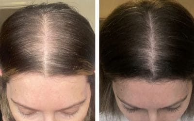 Customer photo review of Hair Biolabs® | Sistema de Microinfusión para el crecimiento del cabello