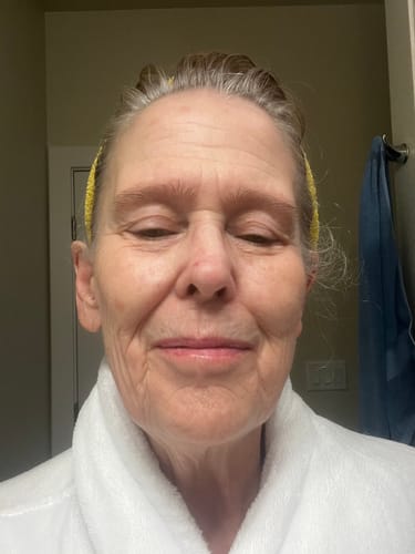 Customer's face showing skin texture before starting the Micro Infusion System treatment.