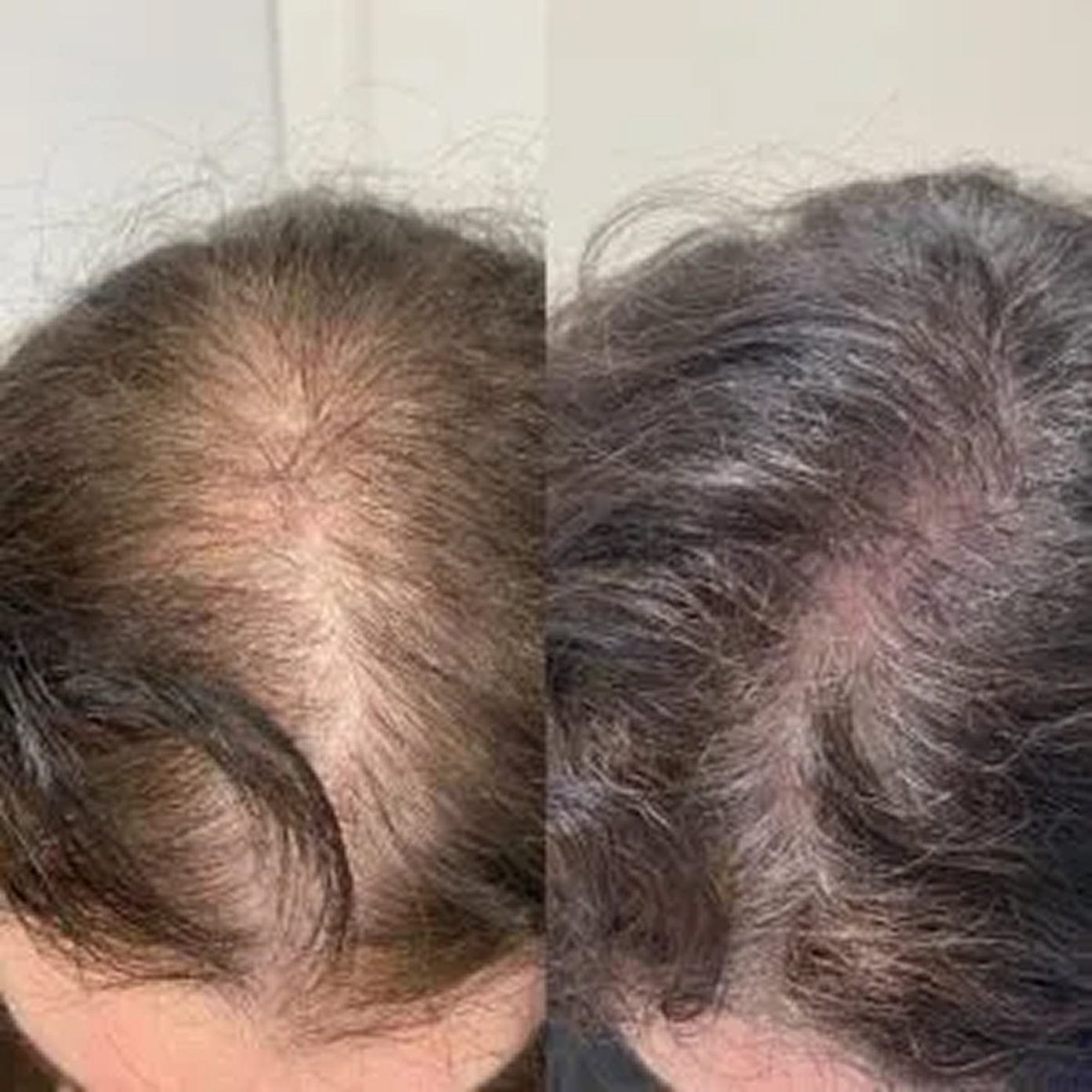 Customer photo review of Hair Biolabs® | Sistema de Microinfusión para el crecimiento del cabello