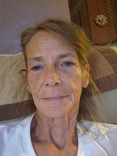 Customer's face after using The Micro Infusion System for skin rejuvenation and wrinkle reduction.