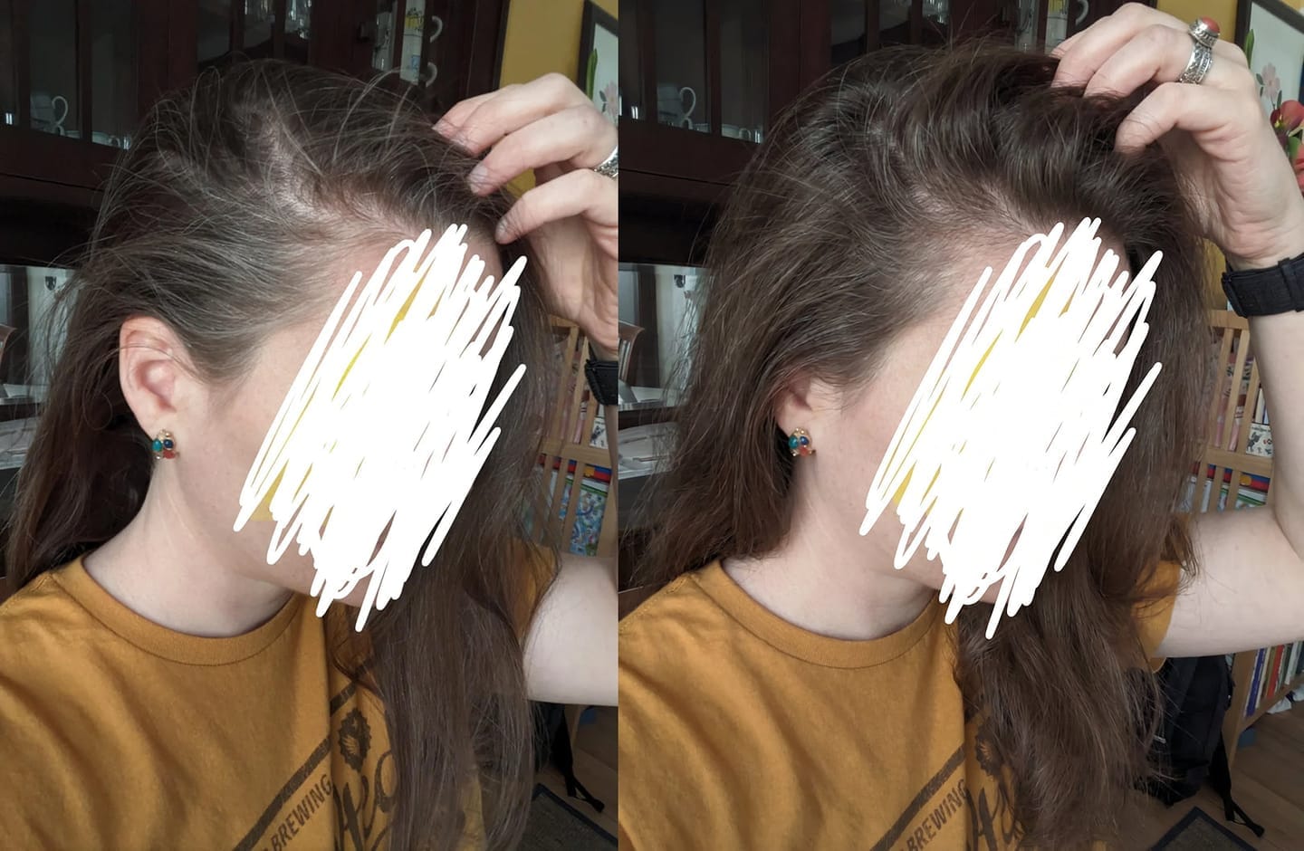 Customer photo review of Hair Biolabs® | Sistema de Microinfusión para el crecimiento del cabello