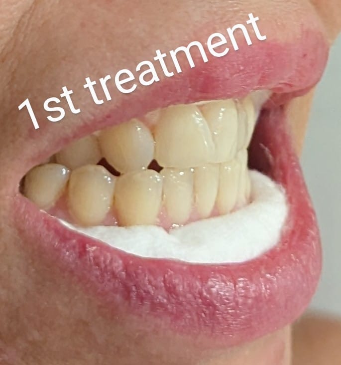 Customer photo review of Composite Care Bundle
