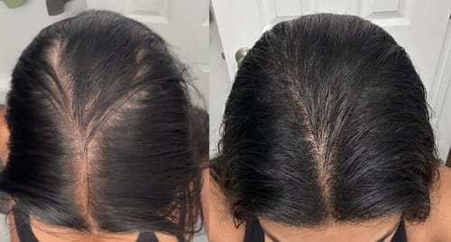 Customer photo review of Hair Biolabs® | Sistema de Microinfusión para el crecimiento del cabello