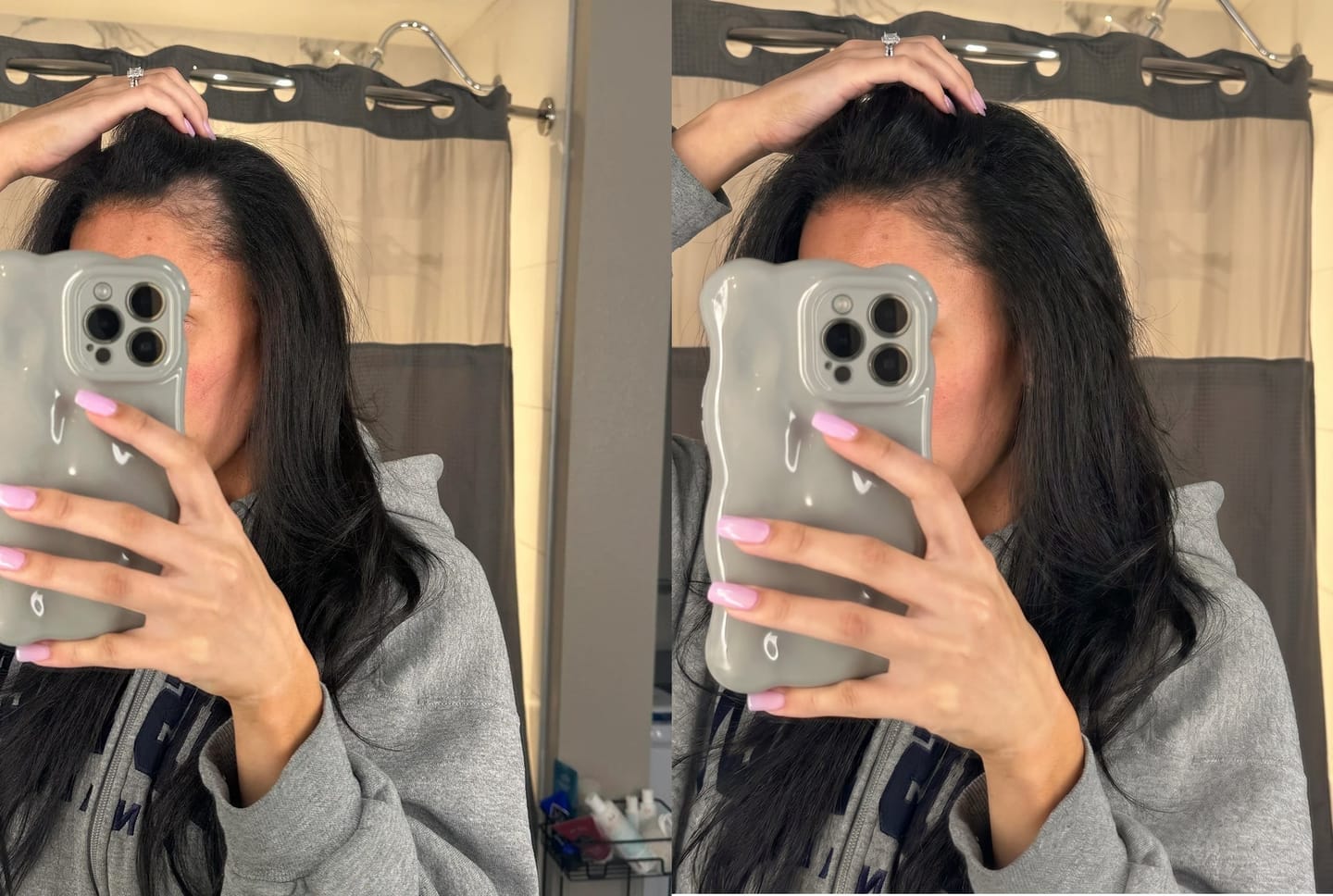 Customer photo review of Hair Biolabs® | Sistema de Microinfusión para el crecimiento del cabello