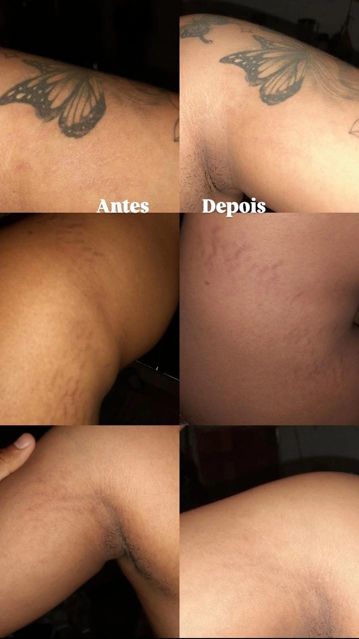 Customer photo review of Creme Antiestrias Regenerador Dérmico